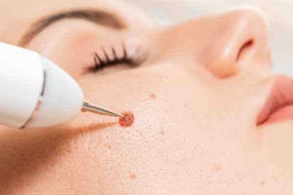 Actinic Keratoses: Treatment Options and What You Need to Know 2 Could Cryotherapy Be Suitable for an Actinic Keratosis?