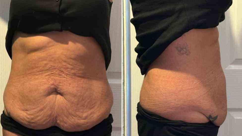 Lost the Weight but Not the Loose Skin? What You Should Know 1 Is It Definitely Loose Skin Northamptonshire?